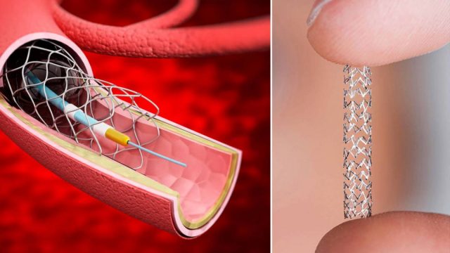 Qué es un Stent cuántos tipos hay y cómo es el tratamiento