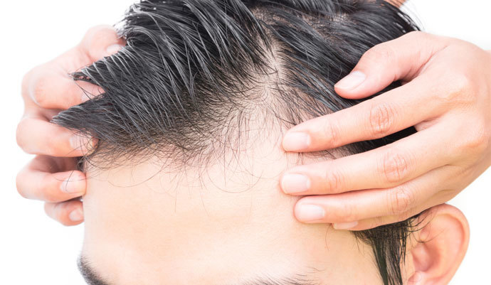 Consejos para evitar la caída de cabello