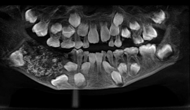 Encuentran 526 dientes extra en la boca de un niño de tres años