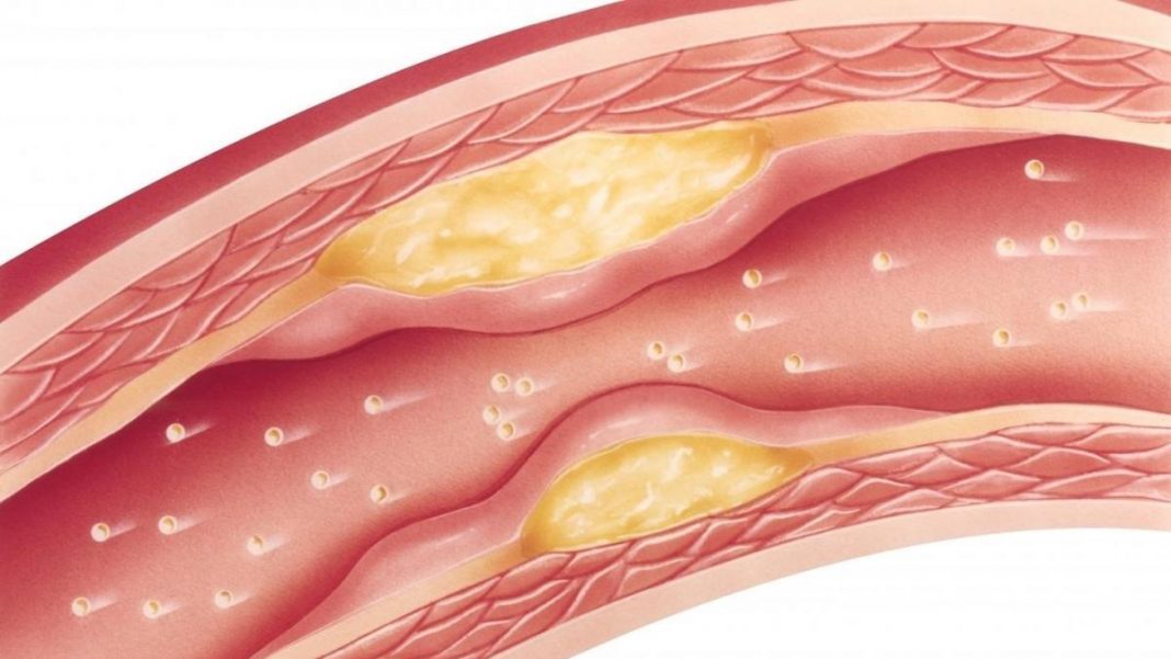 aterosclerosis-desayuno