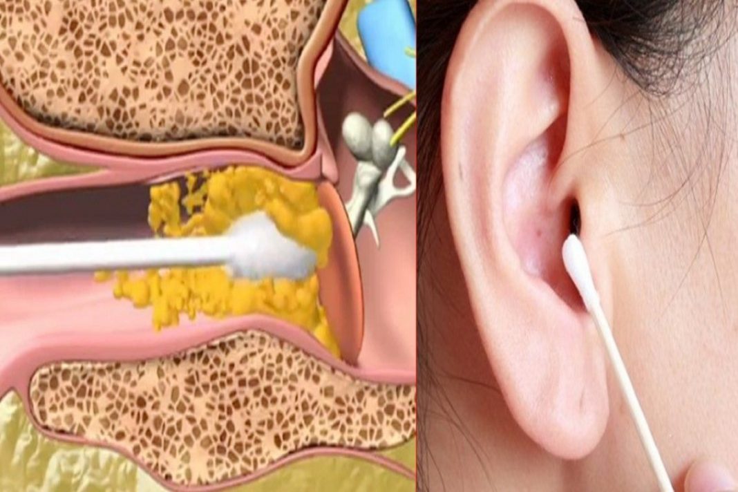 como eliminar la cera de los oídos