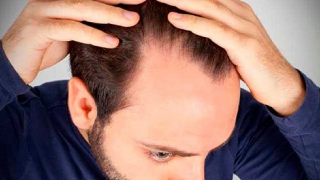 El curioso método para acabar con la caída del pelo