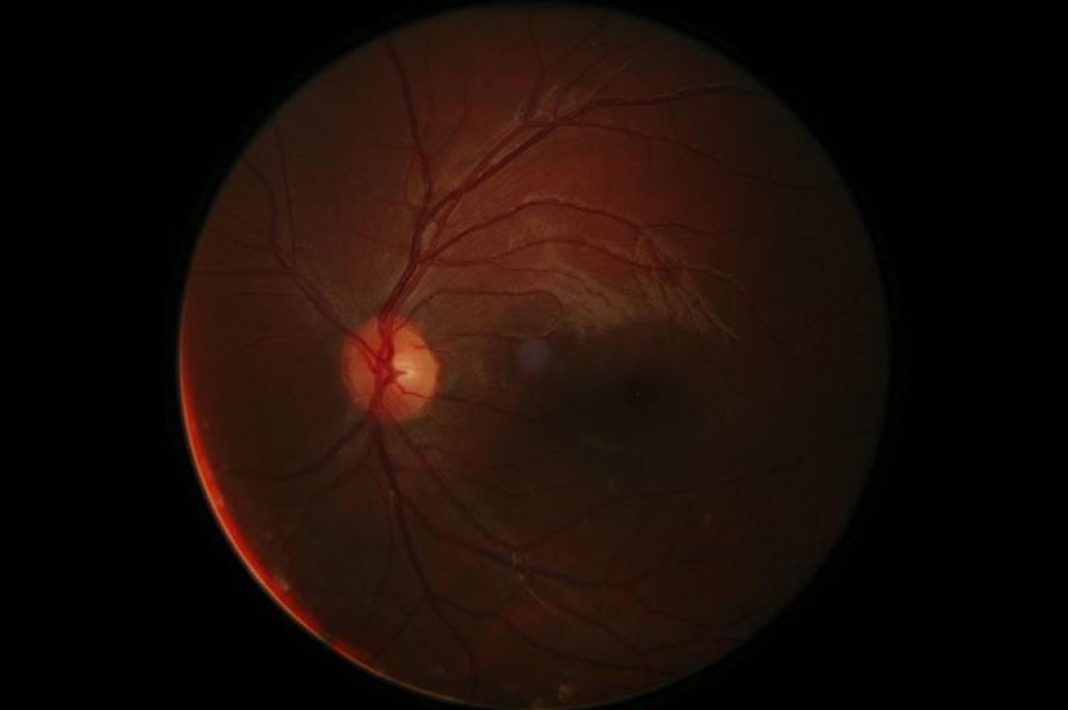 retina