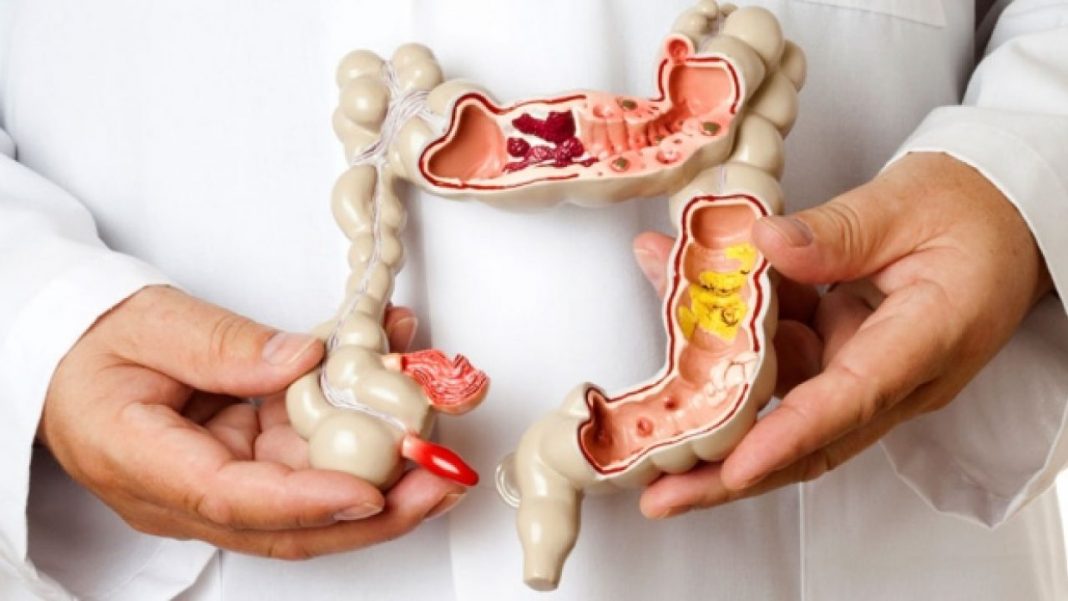 Alimentos que no deberías tomar si tienes colon irritable