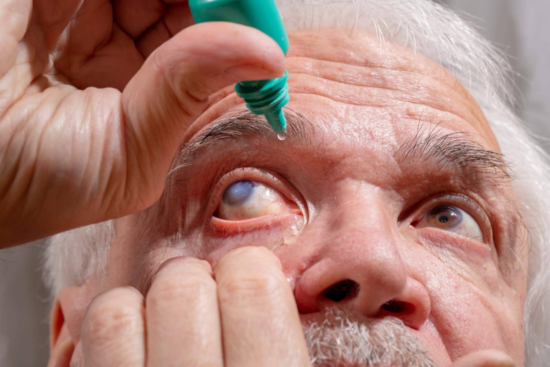Conocer Los Síntomas Y Tratamientos Del Glaucoma Con El Departamento De Oftalmología Del 5745