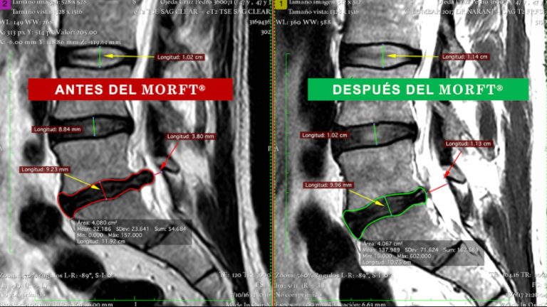 El método MORFT® rehabilita a pacientes que viven con protusión y/o hernia discal sin medicamentos ni cirugías