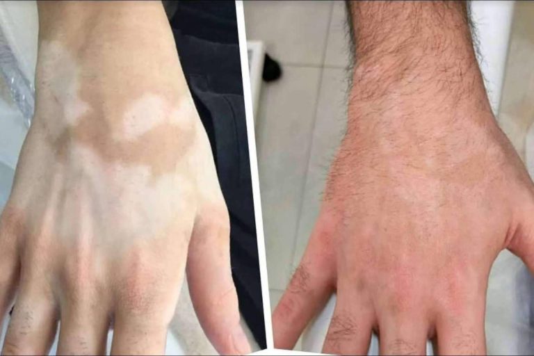 Dermopigmentación Clínica dispone del TERAV tratamiento estético de repigmentación artificial para vitiligo