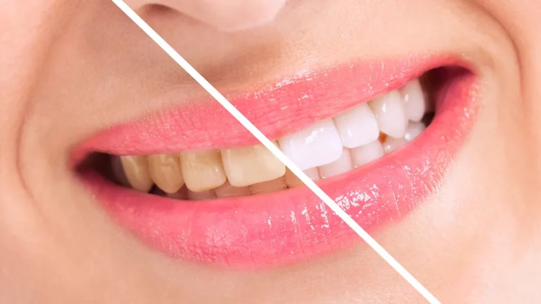 ¿Qué alternativas existen para blanquear los dientes de forma segura?